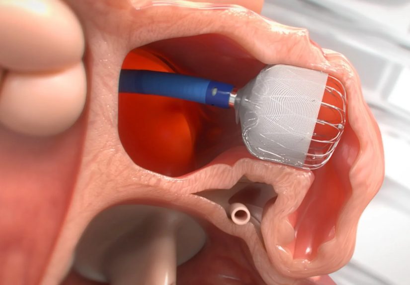 Advances in AFib Treatment and Prevention