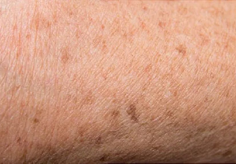 Causes, Treatments, and Prevention of Age Spots