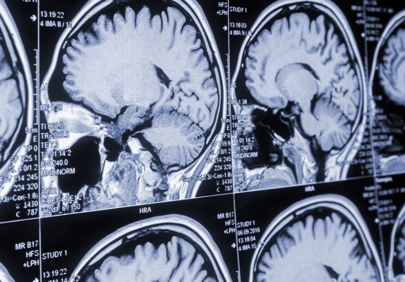 Gerstmann-straussler-scheinker: Symptoms, treatment, and more