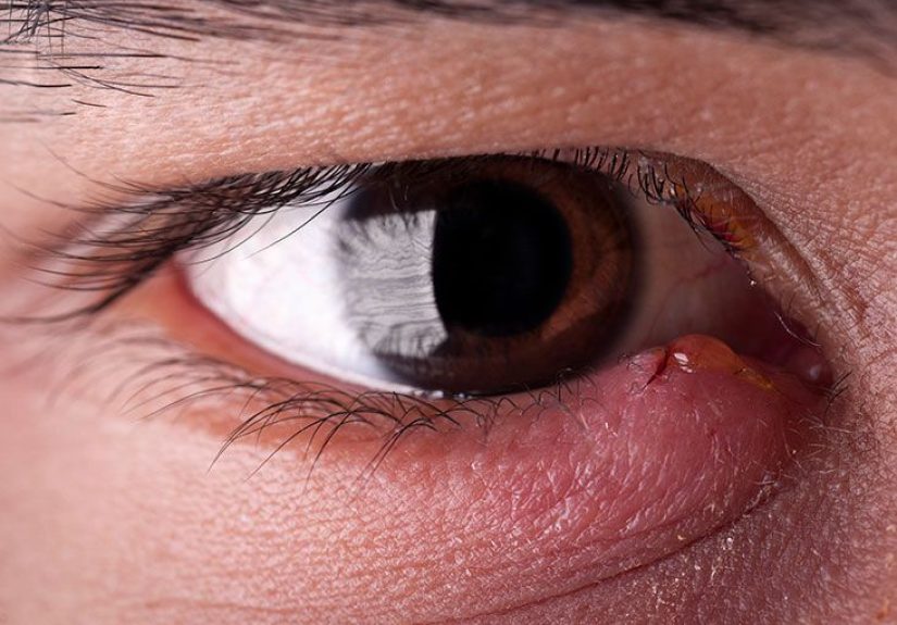 How long does a stye last? Duration and treatment