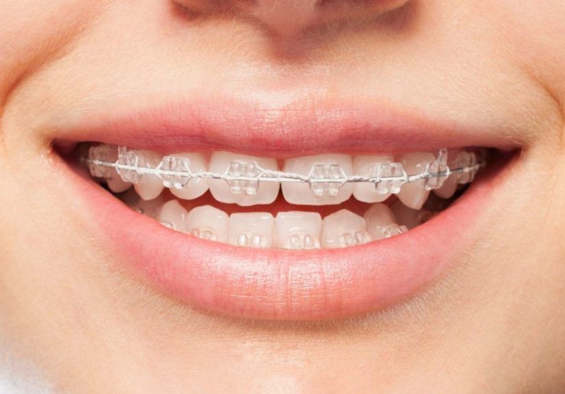 Orthodontics: Maloccclusion, Other Problems, and Starting Treatment