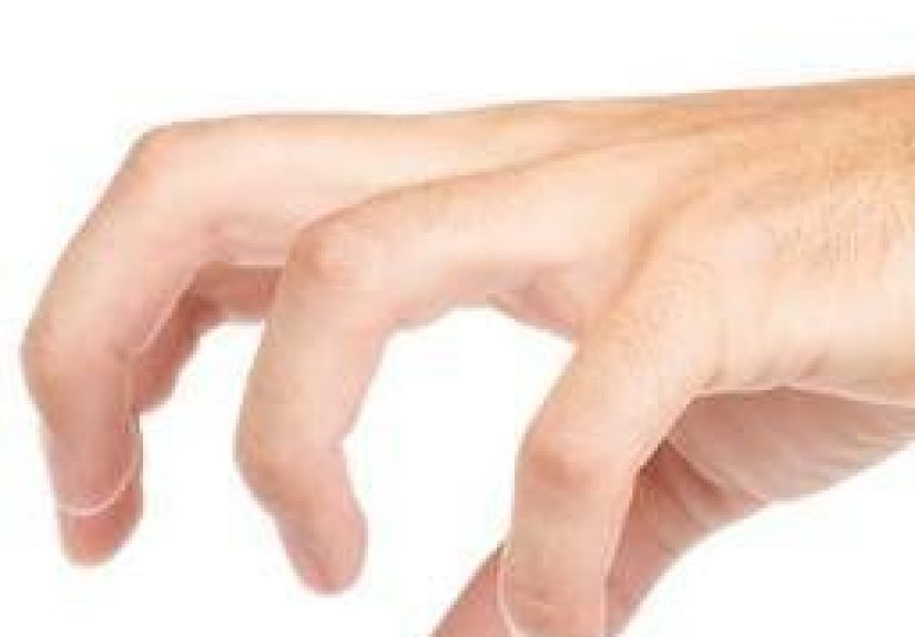 Sclerodactyly: What It Is, Causes, and Treatment