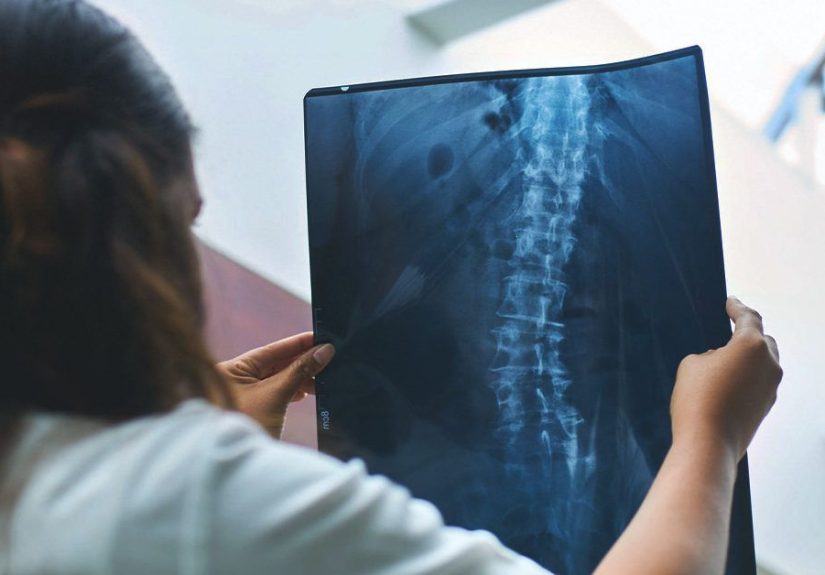Scoliosis: Types, Causes, and Symptoms