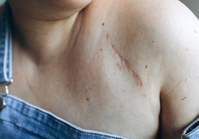 Skin Cancer in Scars: What You Need to Know
