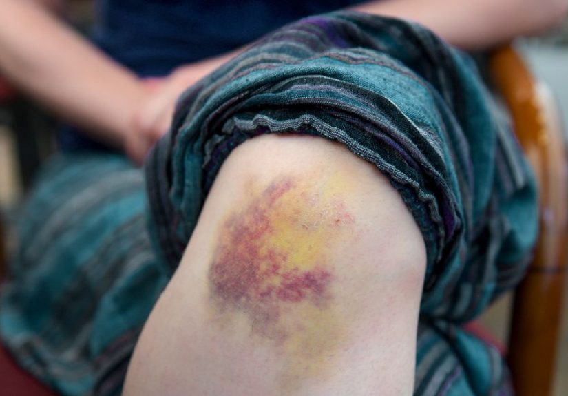 Why Do My Bruises Have So Many Different Colors?