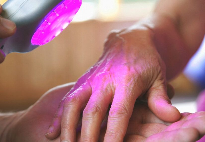 XTRAC Laser Therapy for Psoriasis: Does It Work?