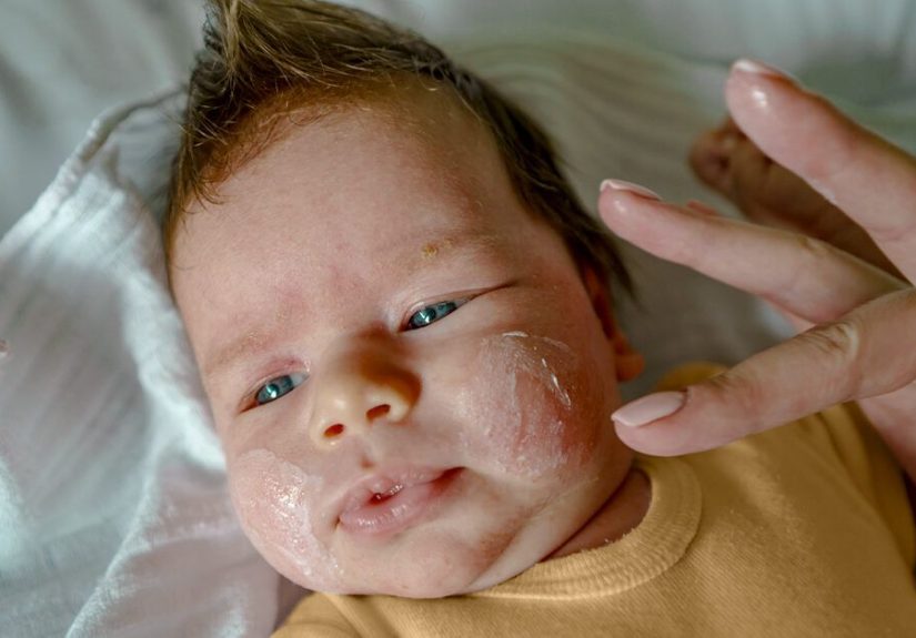 Eczema on Child’s Face: Causes, Diagnosis, Treatment, and More