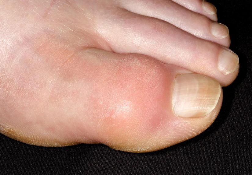 Gout Symptoms and Treatments