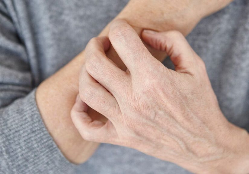 How Do You Get Scabies and Is It Sexually Transmitted?