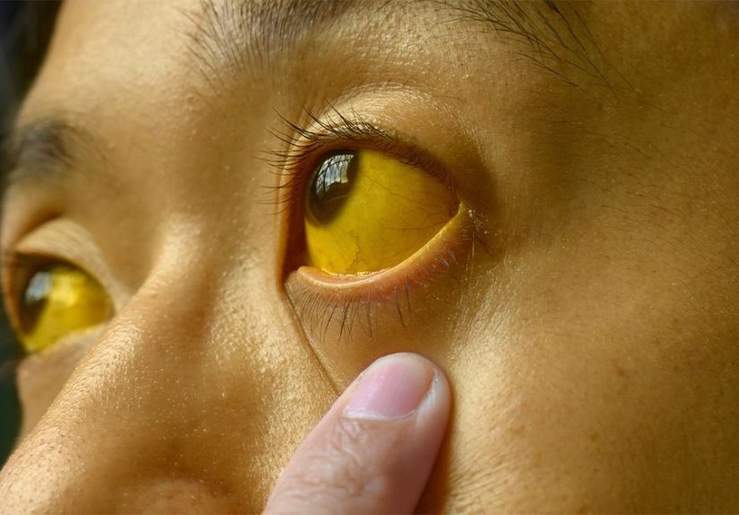 Jaundice: Causes, Symptoms, and Treatments