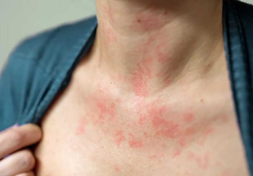 Keto Diet Skin Rash: Why Keto Rash Happens and How to Fix It