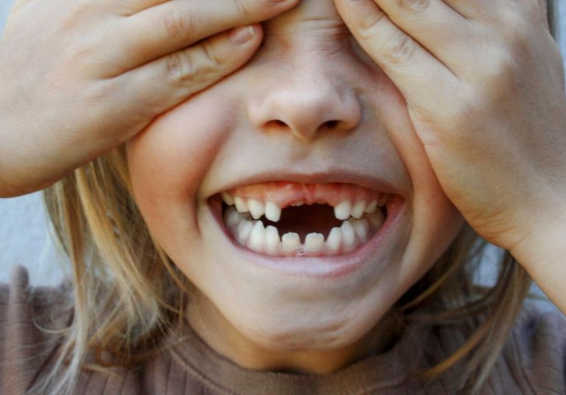 Open Bite: Symptoms, Causes, and Treatment