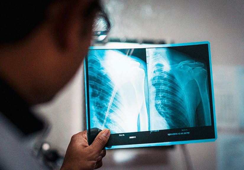 Rheumatoid arthritis in the shoulder: Symptoms, diagnosis, treatment