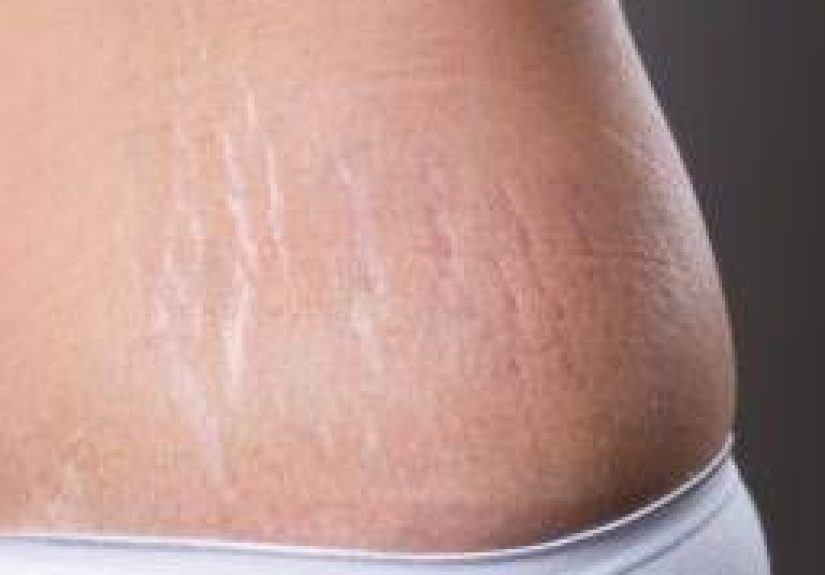 Stretch mark removal: Treatments and home remedies