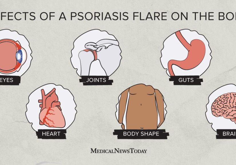 A visual guide to psoriasis flares inside the body