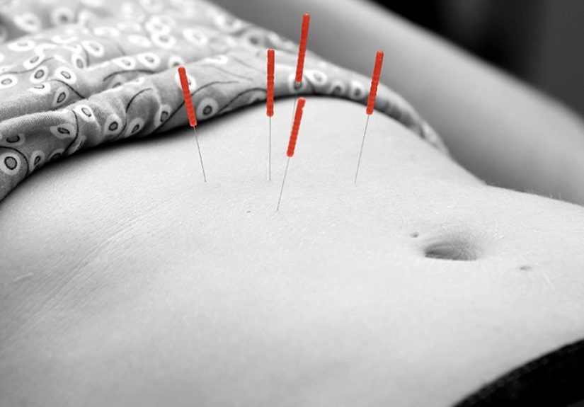 Acupuncture for GERD: Research, alternatives, and FAQs