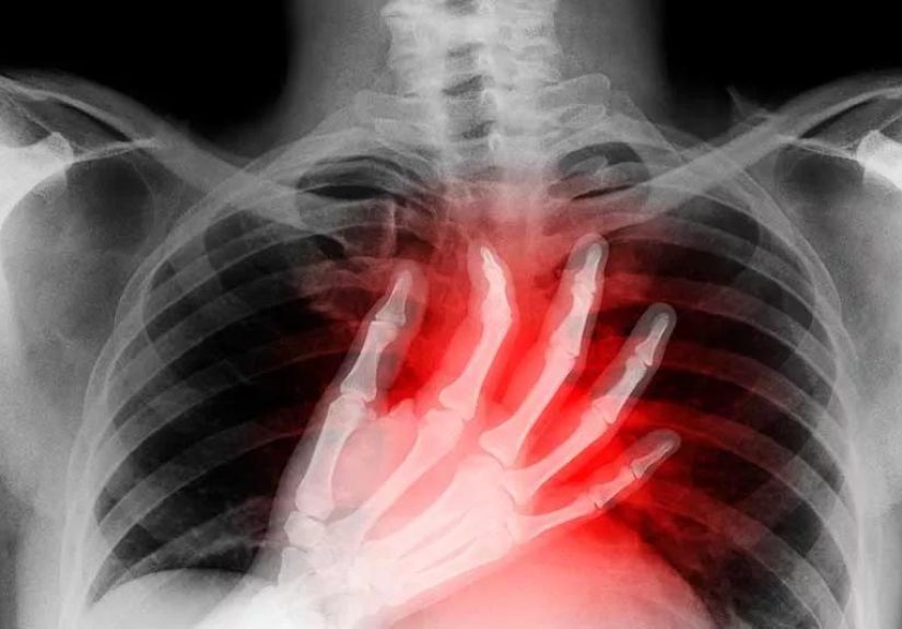 Cardiac Arrest vs. Heart Attack