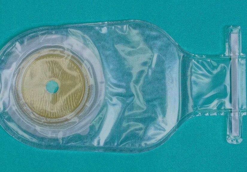 How To Avoid a Colostomy Bag