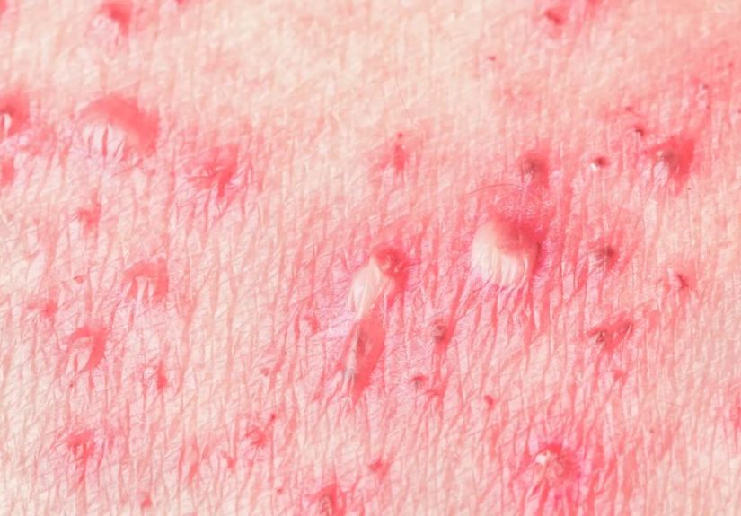 How You Can Avoid Shingles If You Have Cancer