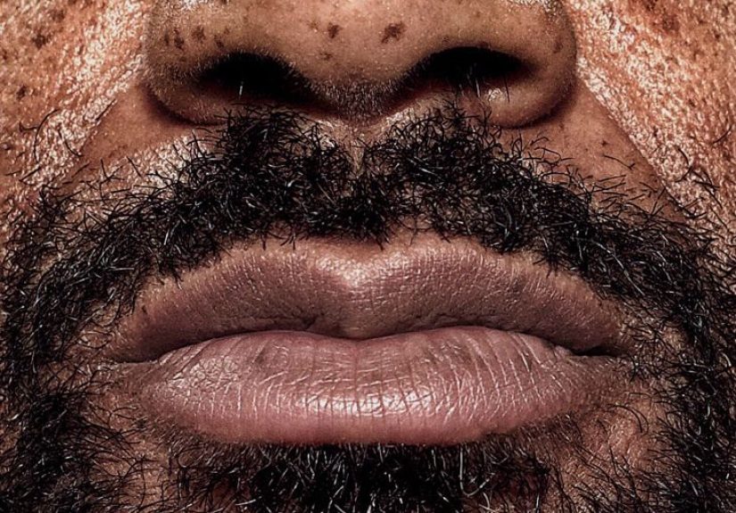 Hyperpigmentation Around Mouth: Causes, Treatment, and Prevention