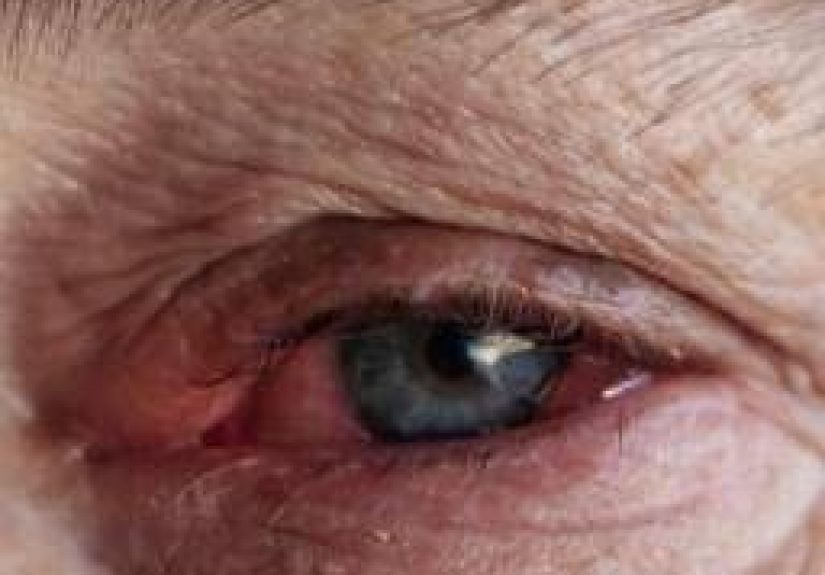Infective conjunctivitis (pink eye): Symptoms, diagnosis, and more