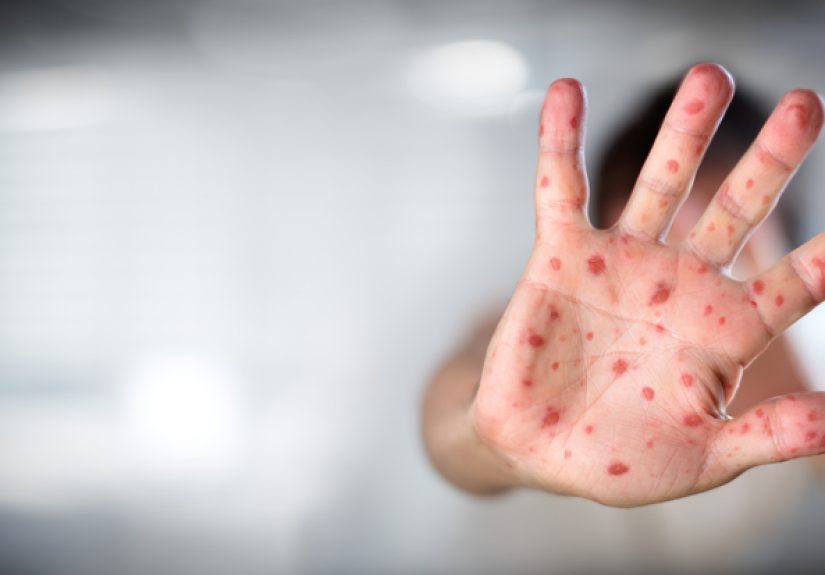 Measles: a preventable disease that is making a comeback