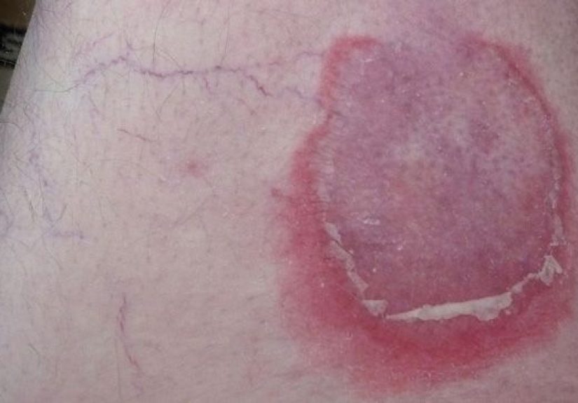 Pemphigoid: Types, Causes, and Symptoms