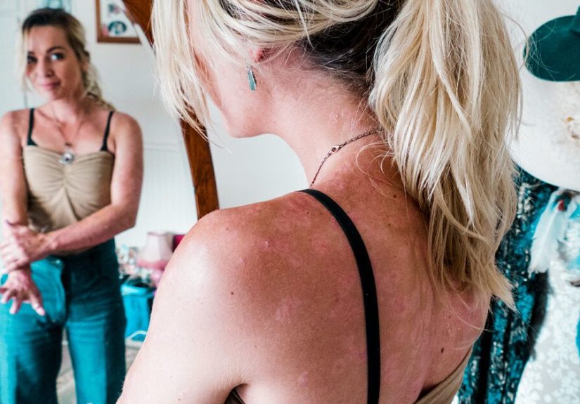 Signs and Symptoms of Psoriasis