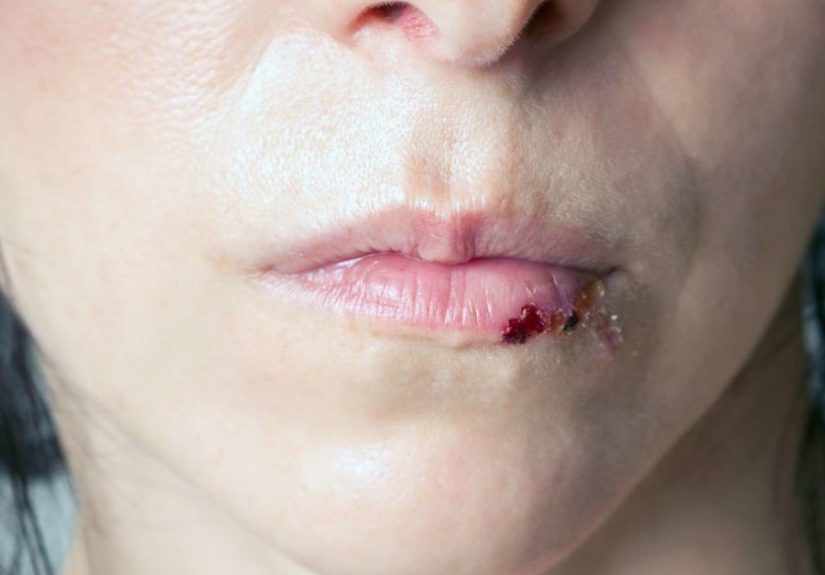 Split lip: Causes, treatments, and home remedies