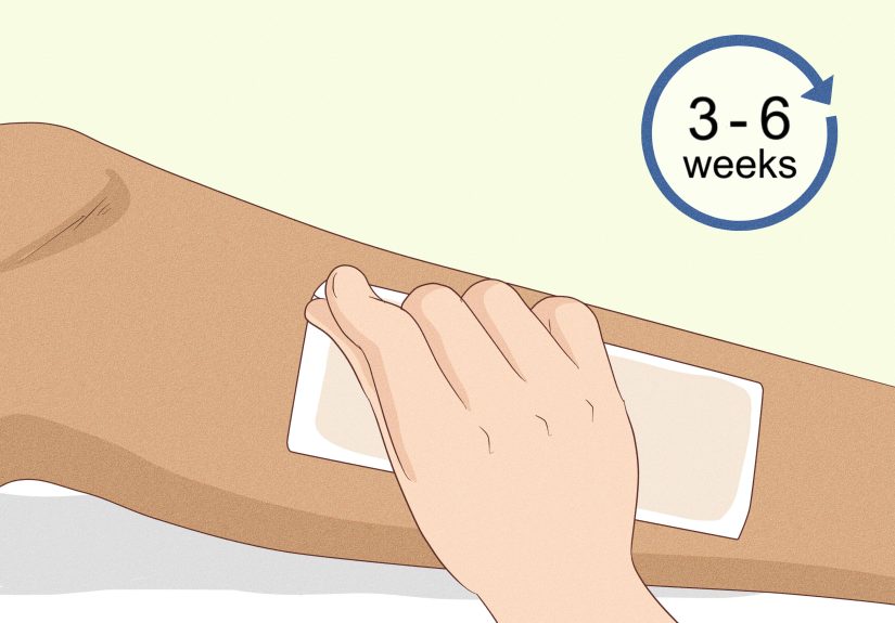 11 Simple Ways to Prevent Ingrown Hairs After Waxing Using Home Remedies