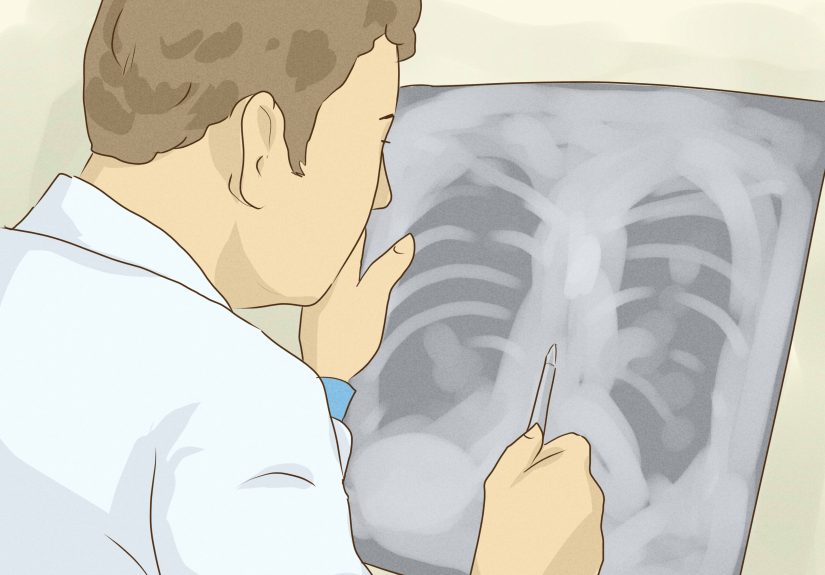 4 Simple Ways to Test for Tuberculosis