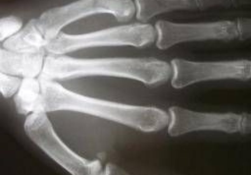 Boxer's fracture: Treatment, diagnosis, and recovery