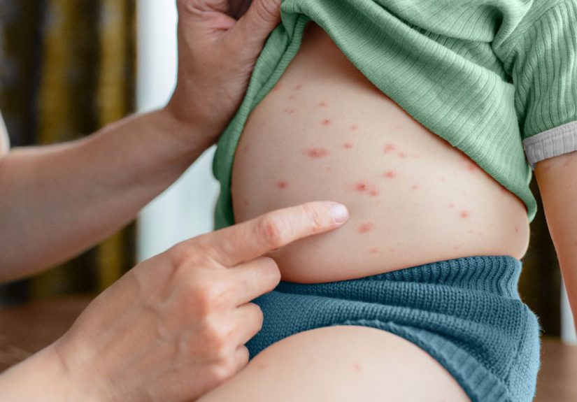 Cutaneous Mastocytosis: Symptoms, Causes, Diagnosis, and Treatment