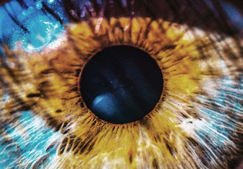 Neovascular macular degeneration: Causes and symptoms