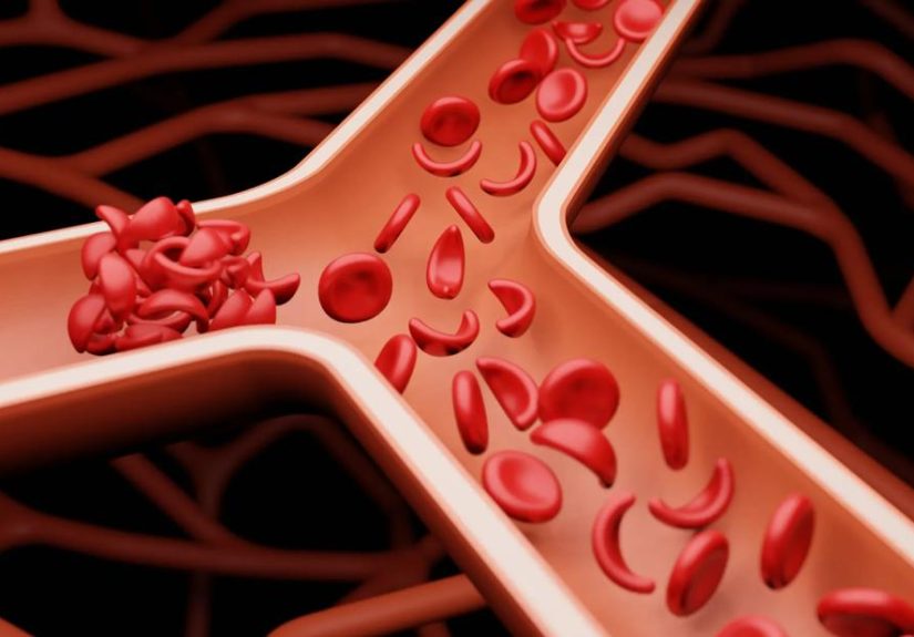 Sickle Cell Disease vs. Trait: What’s the Difference?