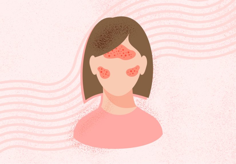 What Is Rosacea? Symptoms, Causes, Diagnosis, Treatment, and Prevention